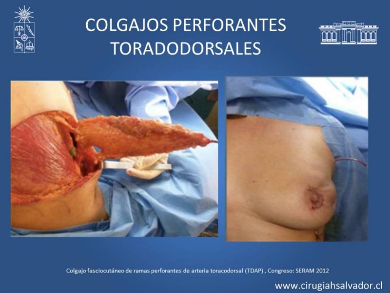 Diapositiva 28 de Aplicación Colgajos Perforantes