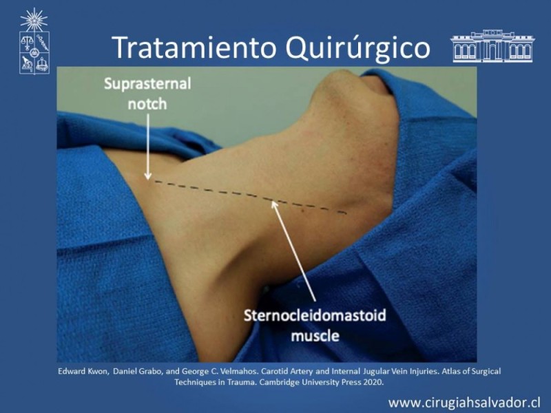 Diapositiva 31 de Trauma Carotídeo