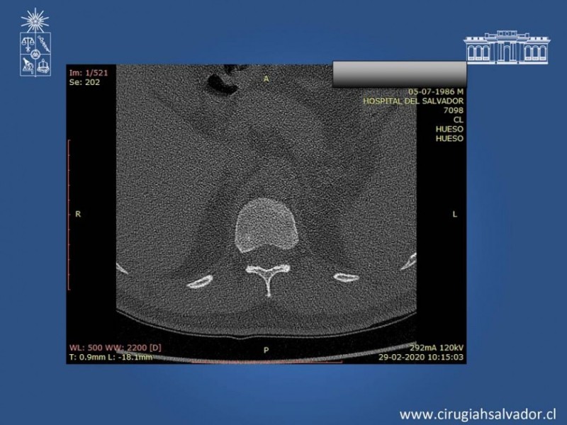 Diapositiva 12 de Trauma Esplénico