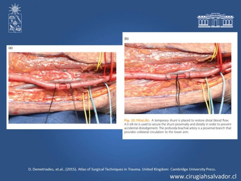 Diapositiva 29 de Trauma Vascular Periférico