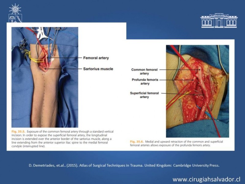 Diapositiva 32 de Trauma Vascular Periférico