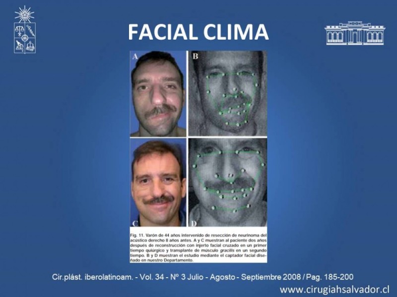 Diapositiva 5 de Injerto Nervioso facial vs transposición Nervio Masetérico