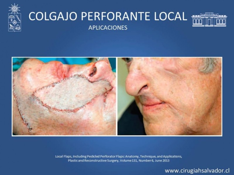 Diapositiva 24 de Aplicación Colgajos Perforantes