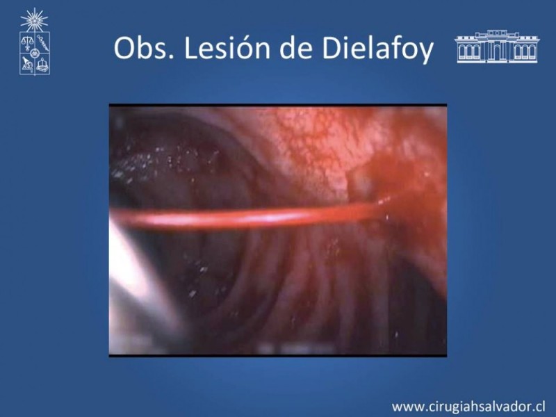 Diapositiva 8 de Hemorragia digestiva alta