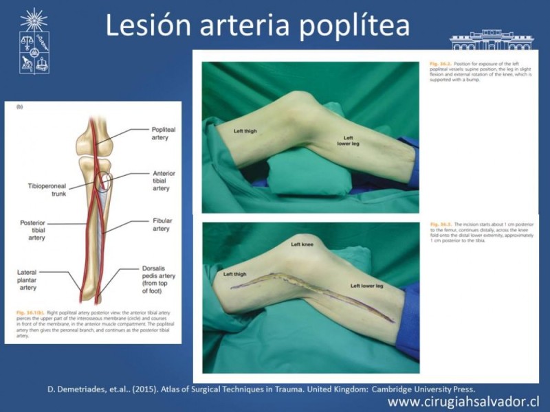 Diapositiva 33 de Trauma Vascular Periférico