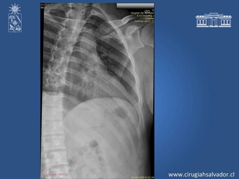 Diapositiva 11 de Trauma Esplénico