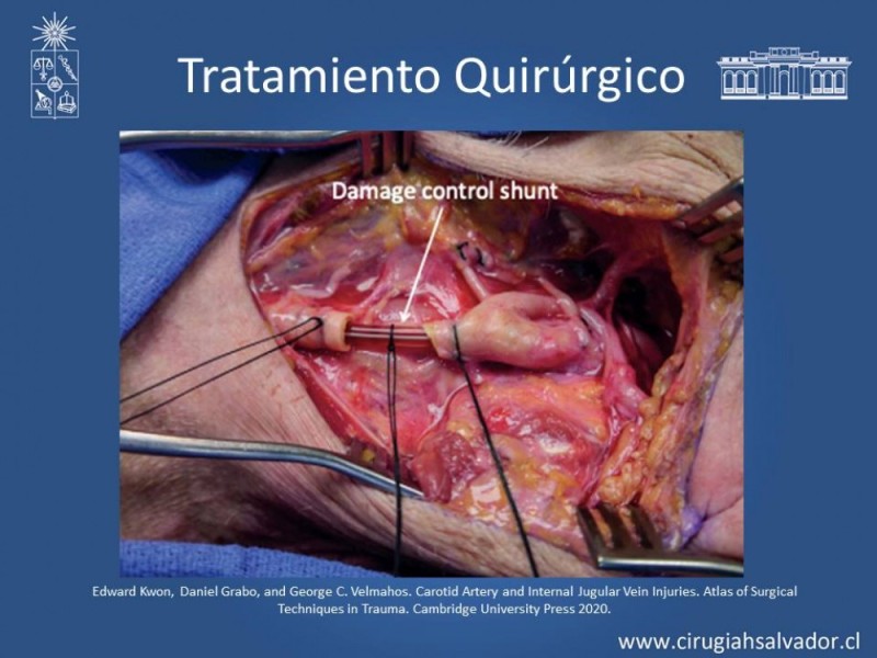 Diapositiva 37 de Trauma Carotídeo