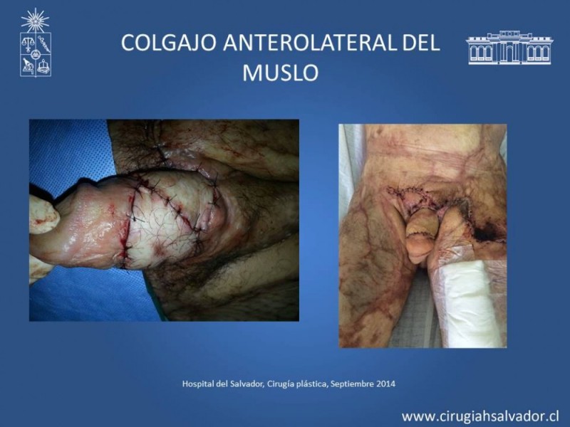 Diapositiva 36 de Aplicación Colgajos Perforantes