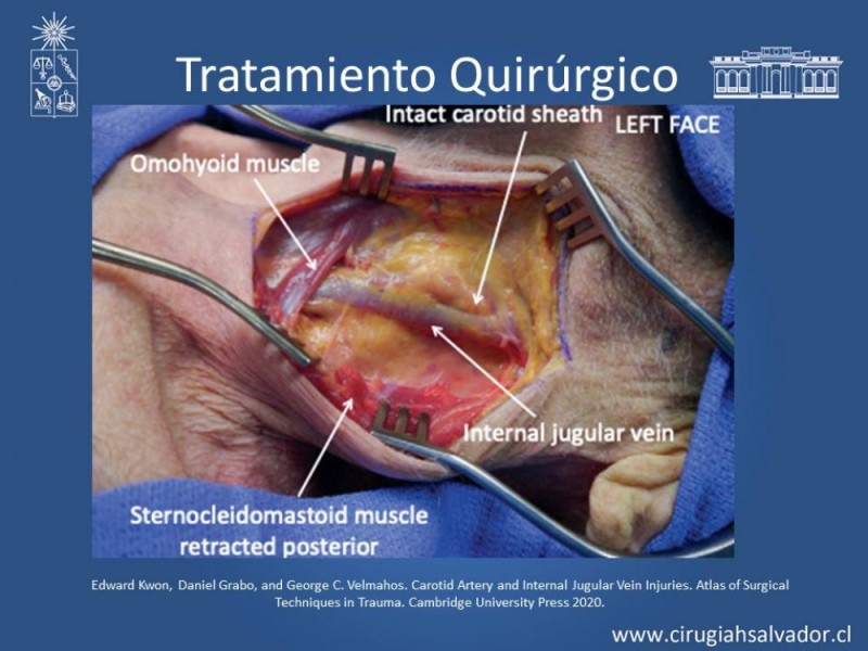Diapositiva 34 de Trauma Carotídeo