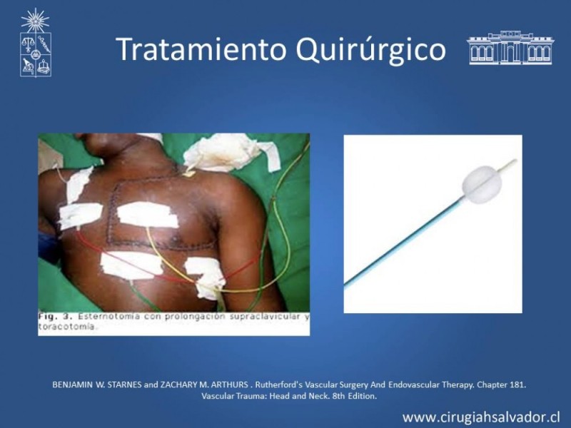 Diapositiva 28 de Trauma Carotídeo