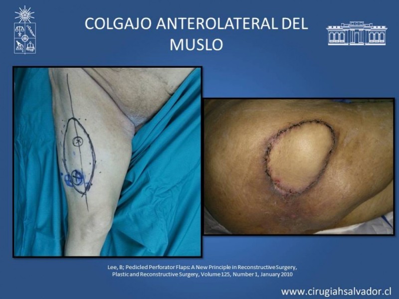 Diapositiva 39 de Aplicación Colgajos Perforantes