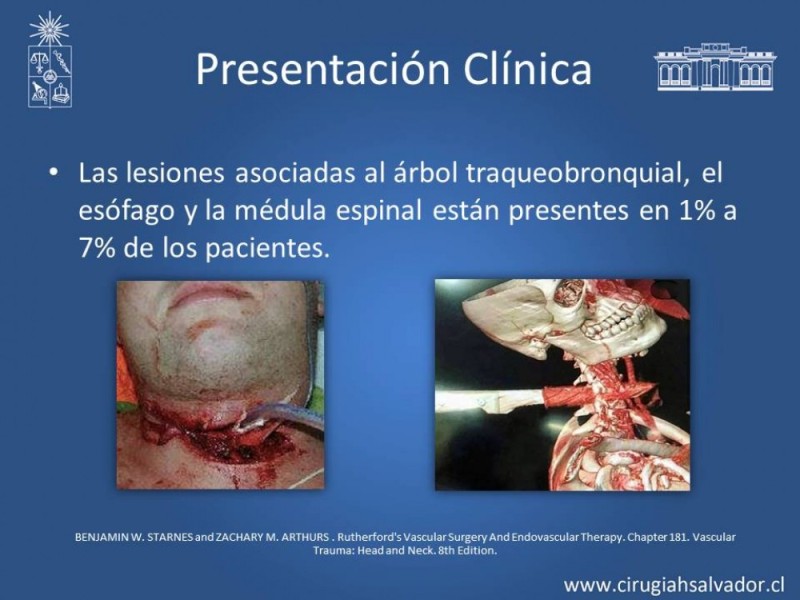 Diapositiva 14 de Trauma Carotídeo