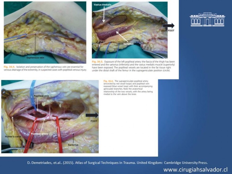 Diapositiva 34 de Trauma Vascular Periférico