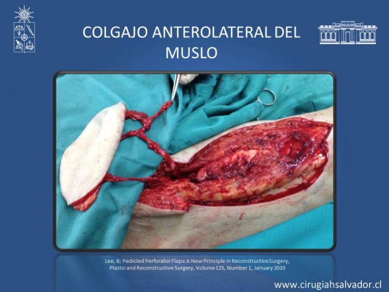 Diapositiva 38 de Aplicación Colgajos Perforantes