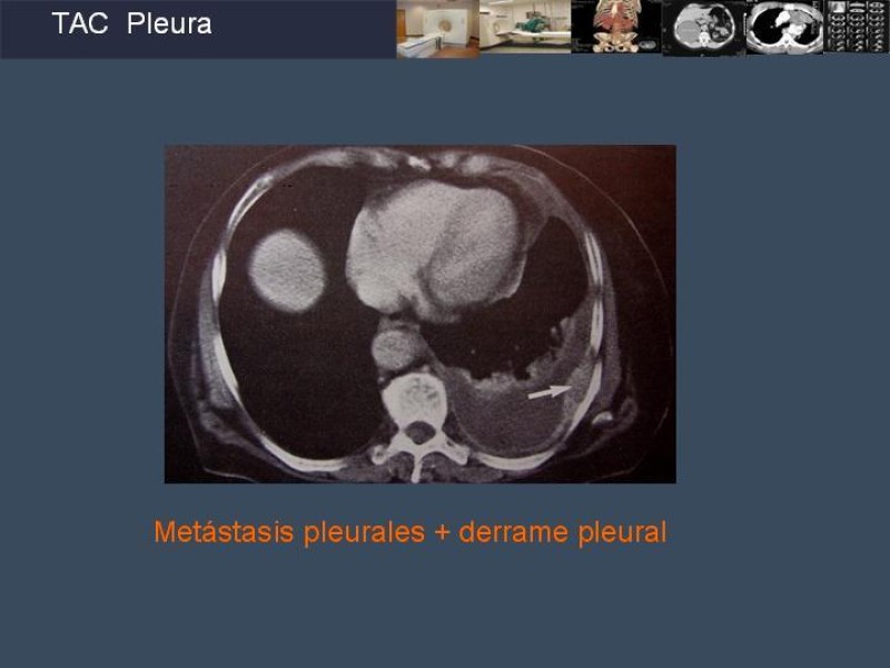 Diapositiva 70 de Imaginología Toráxica TAC