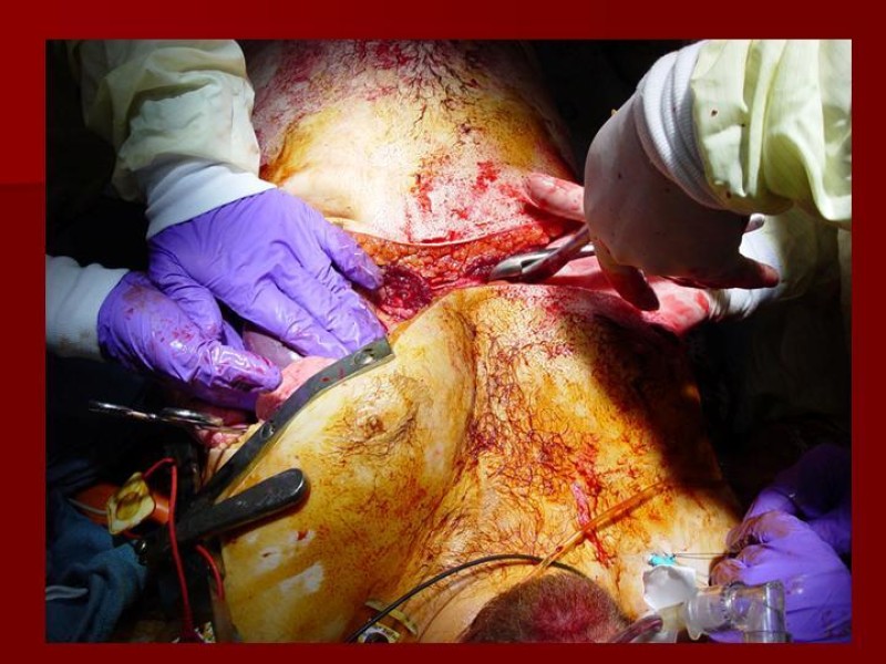 Diapositiva 18 de Toracotomía de Urgencia