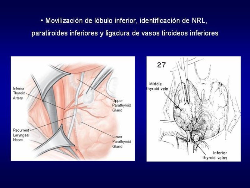Diapositiva 19 de Tiroidectomía