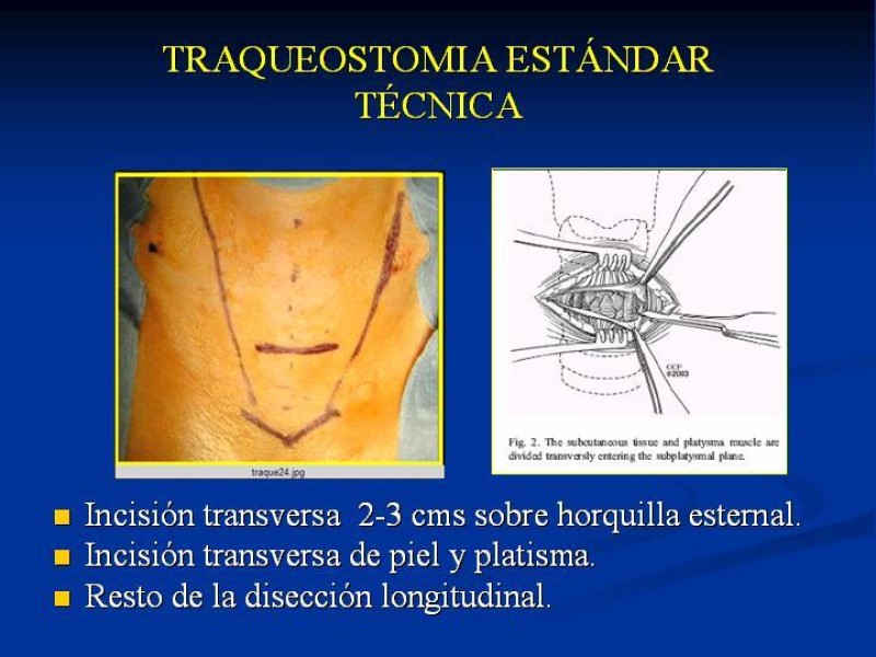 Diapositiva 10 de Traqueostomía Final