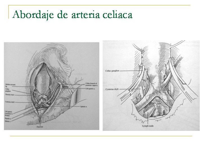 Diapositiva 64 de Accesos vasculares Abdominales