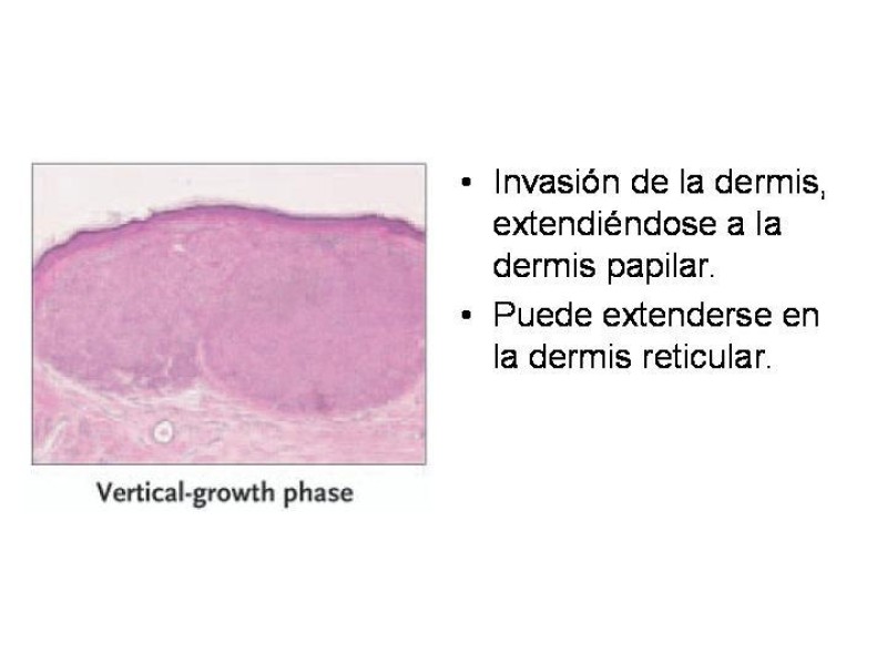 Diapositiva 12 de Melanoma