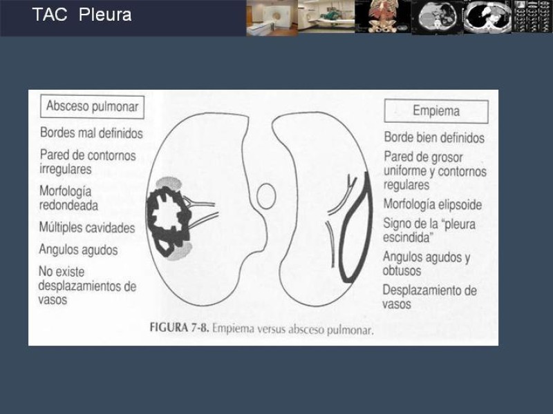 Diapositiva 67 de Imaginología Toráxica TAC