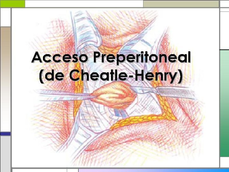 Diapositiva 21 de Tratamiento de la Hernia Femoral
