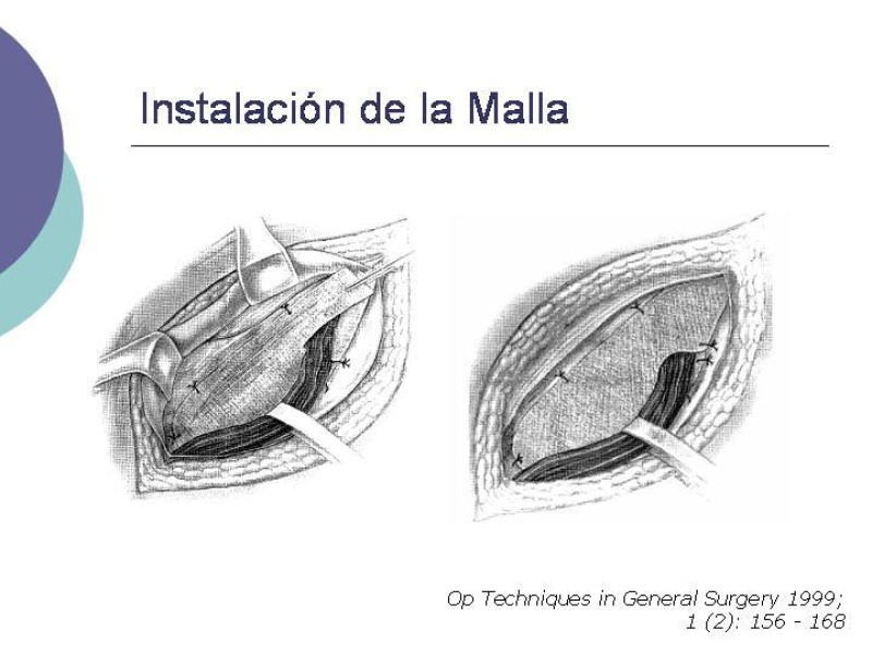 Diapositiva 10 de Hernia Inguinal: Técnica de Lichtenstein