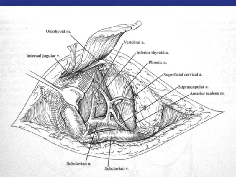 Diapositiva 44 de Abordaje Quirúrgico Vasculares
