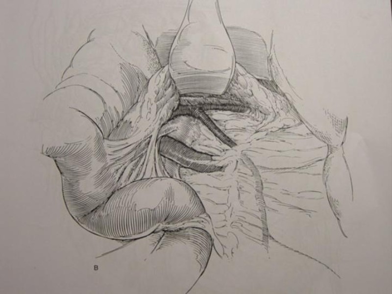 Diapositiva 70 de Accesos vasculares Abdominales