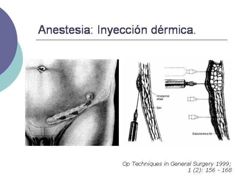 Diapositiva 4 de Hernia Inguinal: Técnica de Lichtenstein