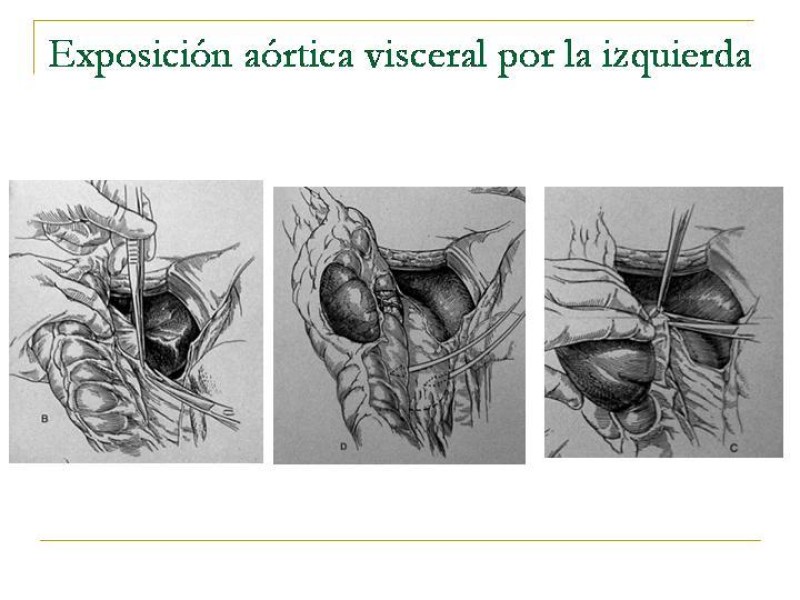 Diapositiva 28 de Accesos vasculares Abdominales