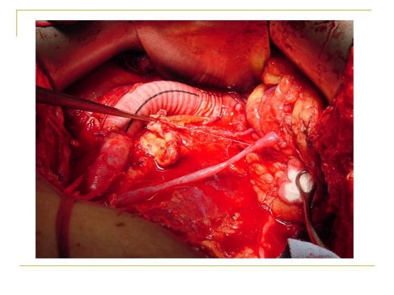 Diapositiva 44 de Accesos vasculares Abdominales