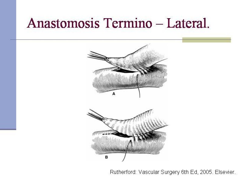 Diapositiva 26 de Reparación y Anastomosis Vasculares
