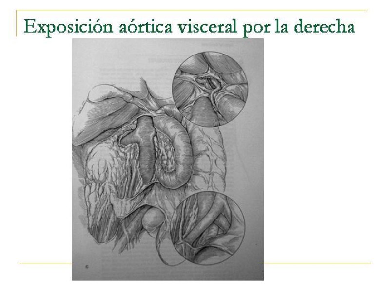 Diapositiva 34 de Accesos vasculares Abdominales