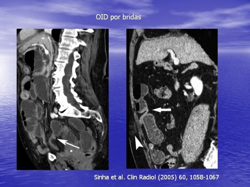 Diapositiva 18 de Obstrucción Intestinal: Estudio Diagnostico y Manejo inicial