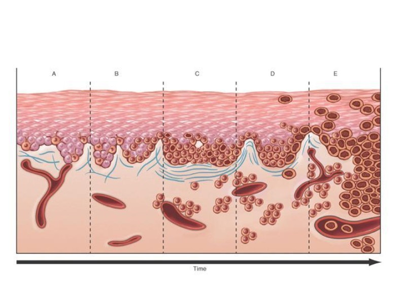 Diapositiva 15 de Melanoma