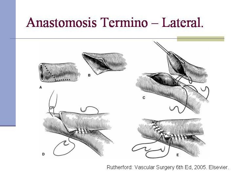 Diapositiva 25 de Reparación y Anastomosis Vasculares