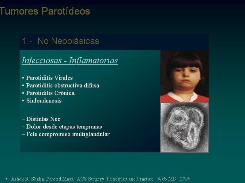 Diapositiva 6 de Masas Parotídeas