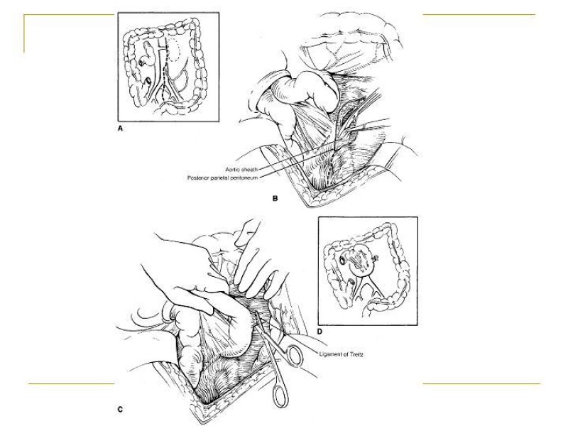 Diapositiva 19 de Accesos vasculares Abdominales