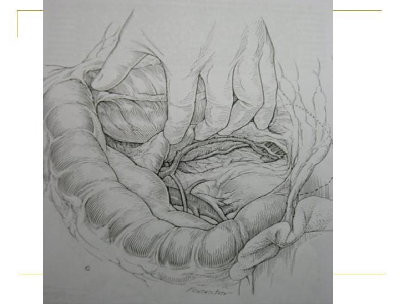 Diapositiva 68 de Accesos vasculares Abdominales