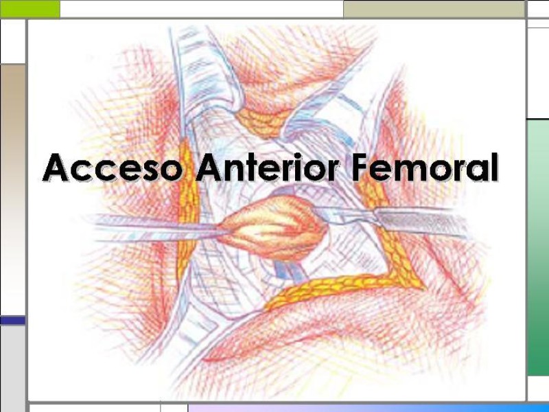 Diapositiva 10 de Tratamiento de la Hernia Femoral
