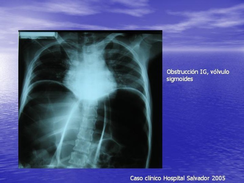 Diapositiva 14 de Obstrucción Intestinal: Estudio Diagnostico y Manejo inicial