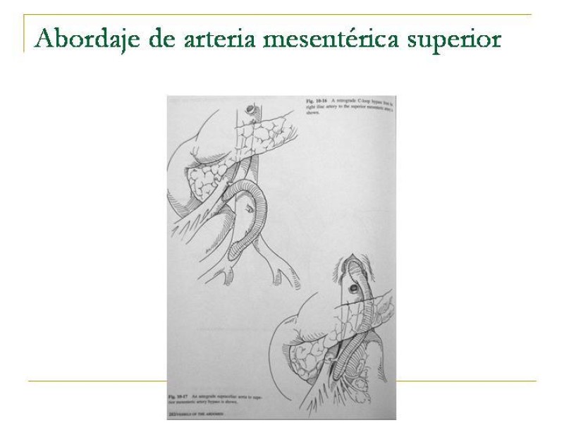 Diapositiva 77 de Accesos vasculares Abdominales