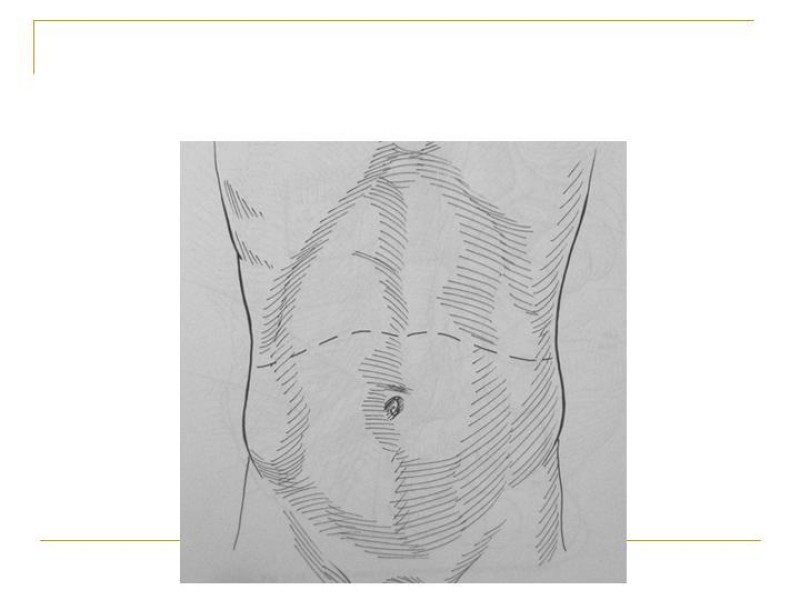 Diapositiva 86 de Accesos vasculares Abdominales