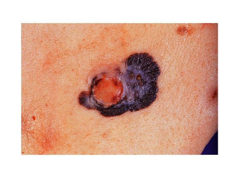 Diapositiva 25 de Melanoma