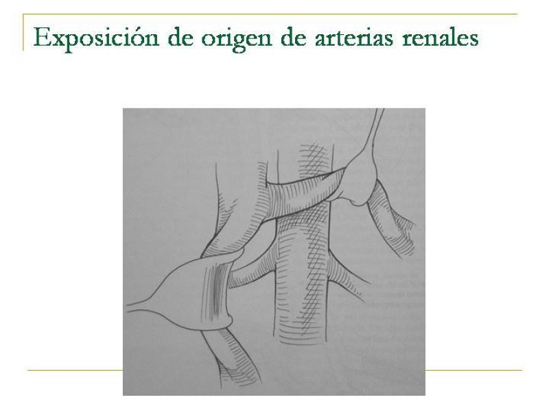Diapositiva 87 de Accesos vasculares Abdominales