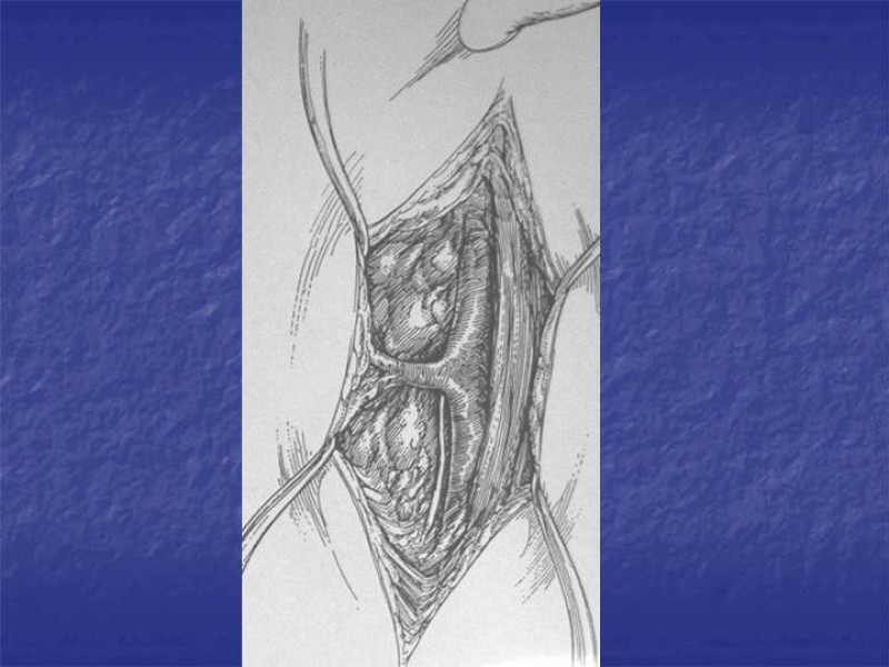 Diapositiva 28 de Abordaje Quirúrgico Vasculares