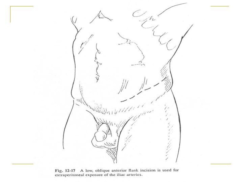 Diapositiva 53 de Accesos vasculares Abdominales