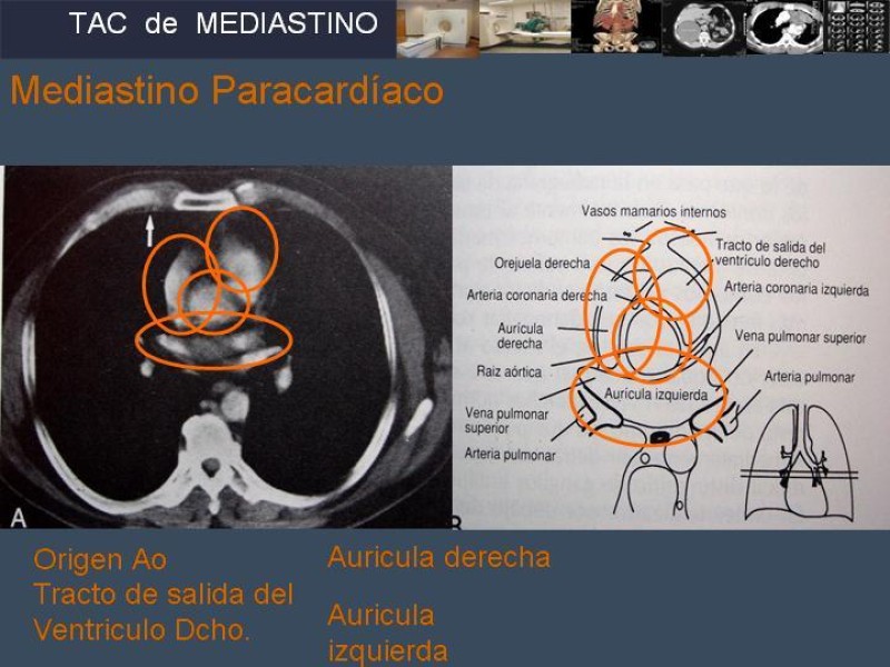 Diapositiva 20 de Imaginología Toráxica TAC