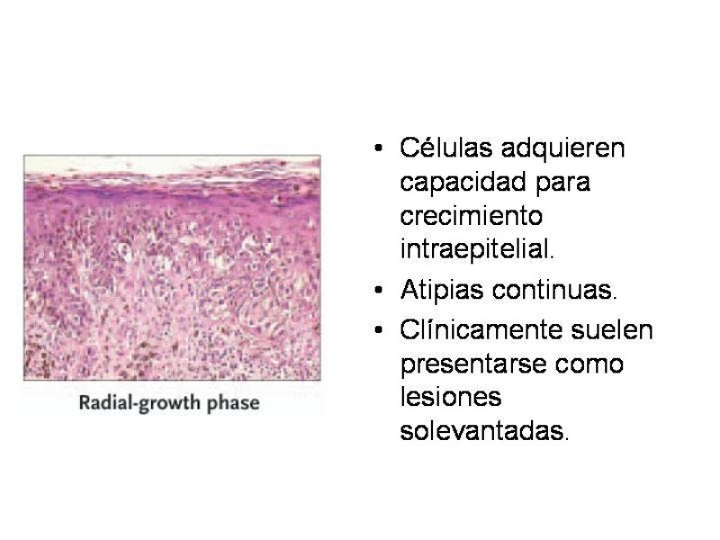Diapositiva 11 de Melanoma